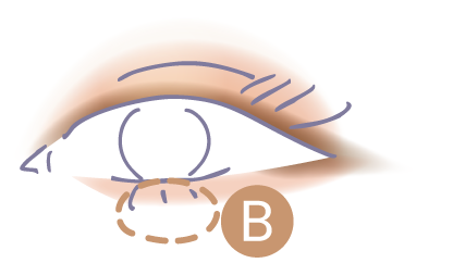STEP4 Bを黒目の下にのせる図解